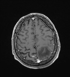 File:Cerebral toxoplasmosis (Radiopaedia 43956-47461 Axial T1 C+ 62).jpg