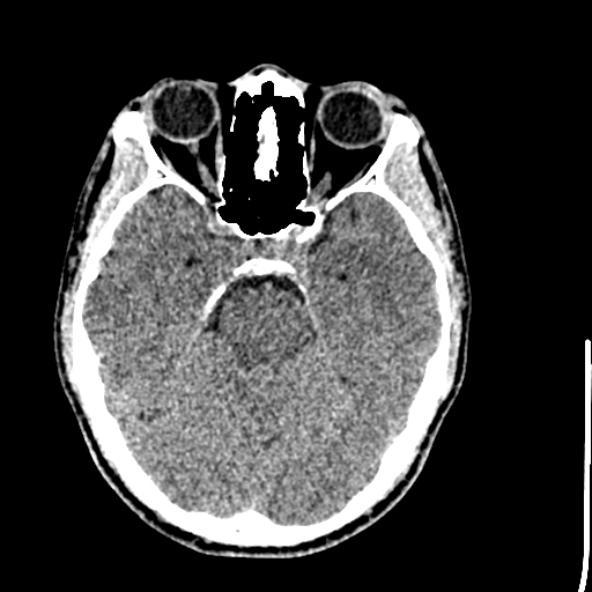 Cerebral toxoplasmosis (Radiopaedia 53993-60131 Axial non-contrast 28).jpg