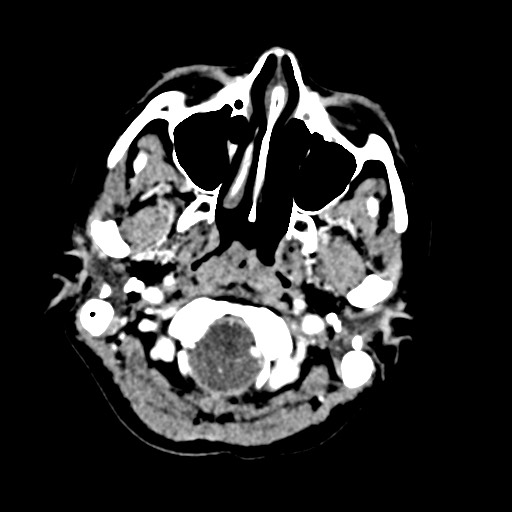 Cerebral tuberculosis with dural sinus invasion (Radiopaedia 60353-68019 Axial C+ delayed 5).jpg