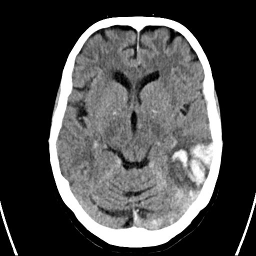 File:Cerebral venous infarction with hemorrhage (Radiopaedia 65343-74381 Axial non-contrast 10).jpg