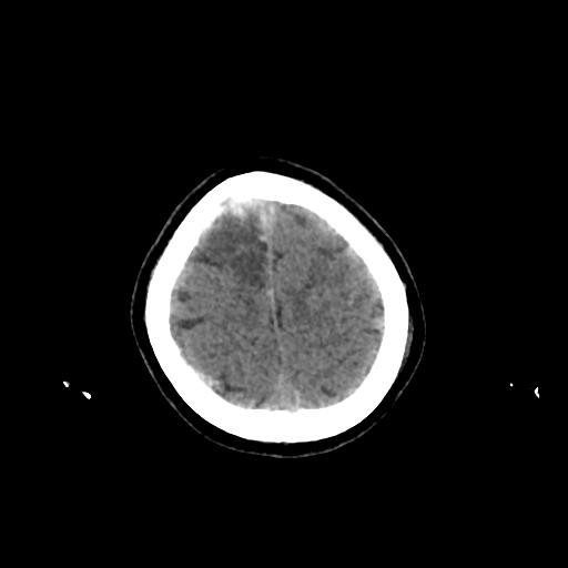 Cerebral venous throbmosis - hemorrhagic venous infarction (Radiopaedia 87318-103613 Axial non-contrast 154).jpg