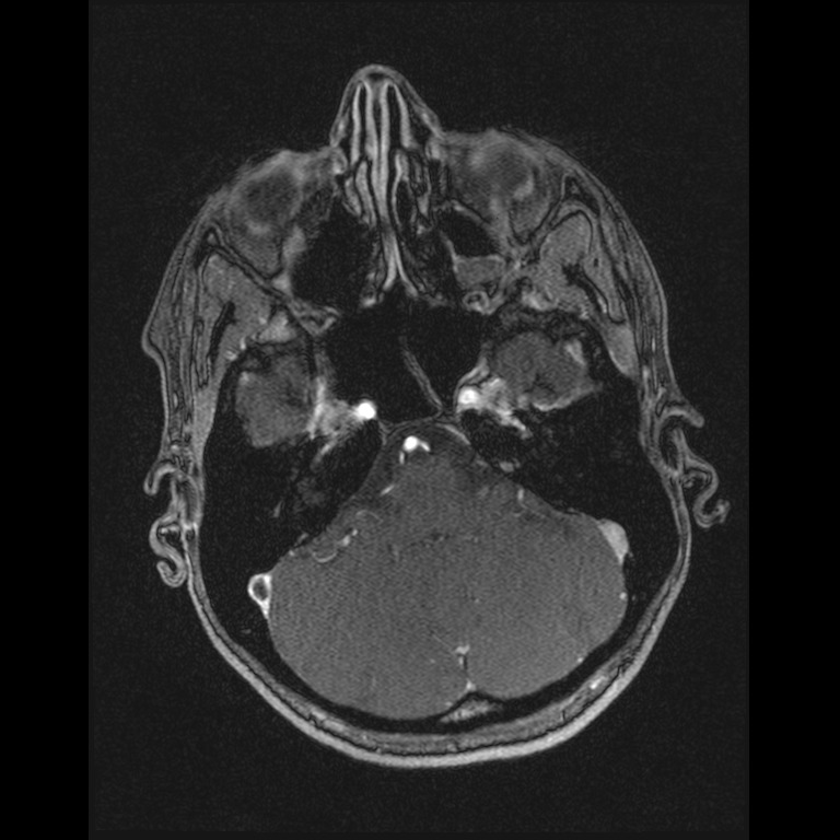 Cerebral venous thrombosis (Radiopaedia 45678-49854 Axial MRV 13).jpg