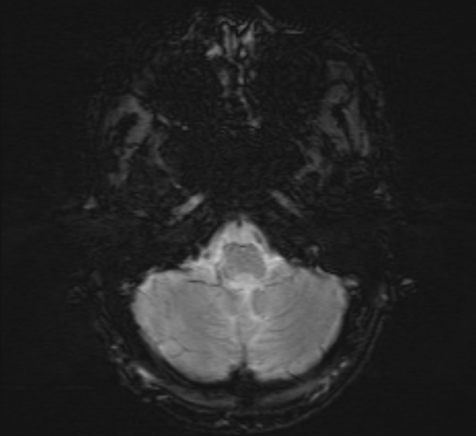 Cerebral venous thrombosis (Radiopaedia 71207-81504 Axial SWI 6).jpg