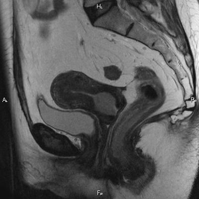 File:Cervical adenocarcinoma (Radiopaedia 65011-73985 Sagittal T2 15).jpg