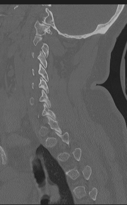 Cervical canal stenosis due to ossification of the posterior longitudinal ligament (Radiopaedia 47260-51823 Sagittal bone window 52).png