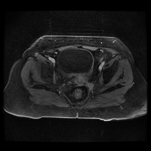 Cervical carcinoma (Radiopaedia 70924-81132 Axial T1 C+ fat sat 138).jpg