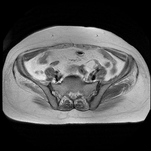 File:Cervical carcinoma (Radiopaedia 88010-104555 Axial T2 4).jpg