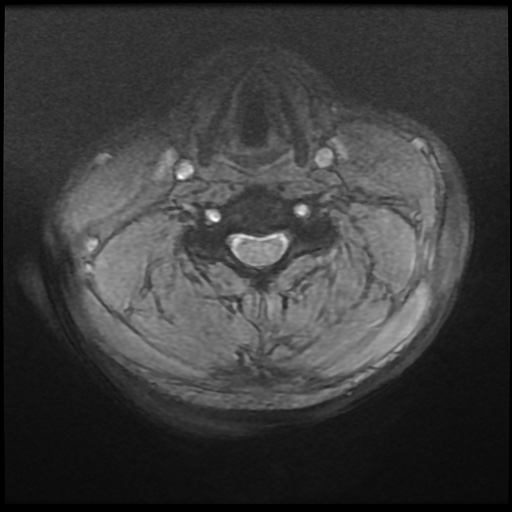 Cervical disc extrusion (Radiopaedia 59074-66364 F 25).jpg