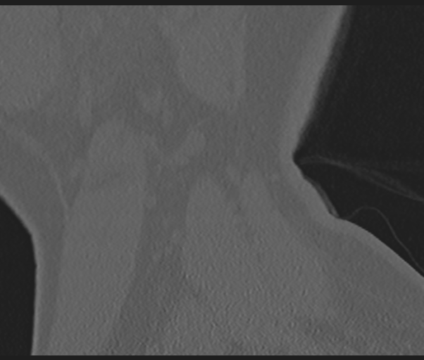 File:Cervical disc replacement (Radiopaedia 44025-47541 Sagittal bone window 6).png