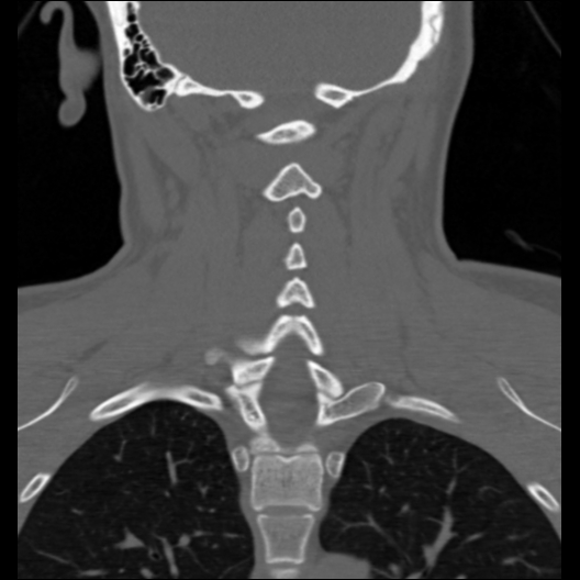 File:Cervical rib (Radiopaedia 71110-81363 Coronal non-contrast 19).jpg