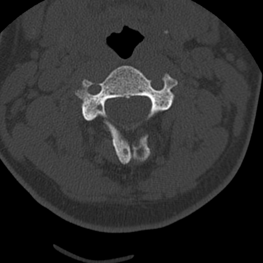 File:Cervical schwannoma (Radiopaedia 57979-64974 Axial bone window 19).png