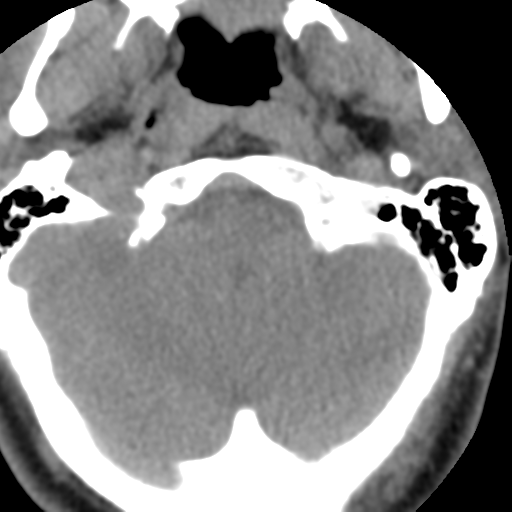 Cervical schwannoma (Radiopaedia 57979-64974 Axial non-contrast 9).png