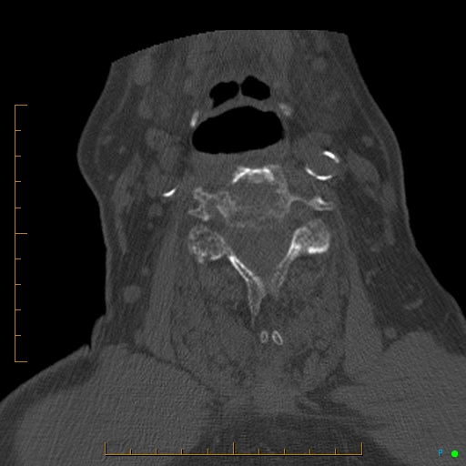 Cervical spine fracture - ankylosing spondylitis (Radiopaedia 76835-88706 Axial bone window 113).jpg