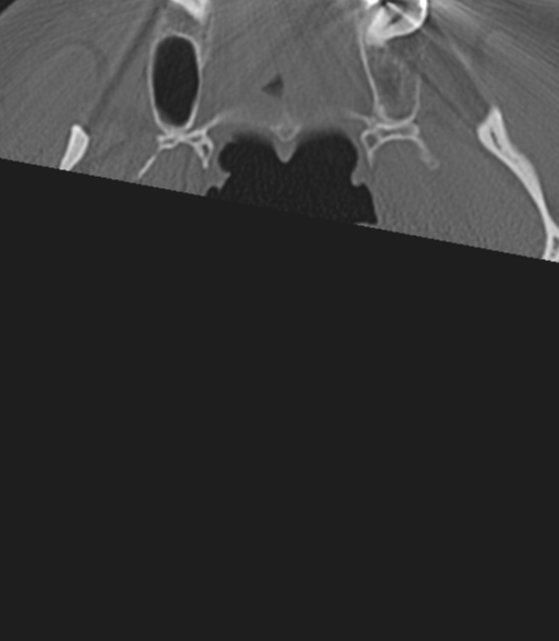 File:Cervical spine fractures with vertebral artery dissection (Radiopaedia 53296-59268 Axial bone window 2).png