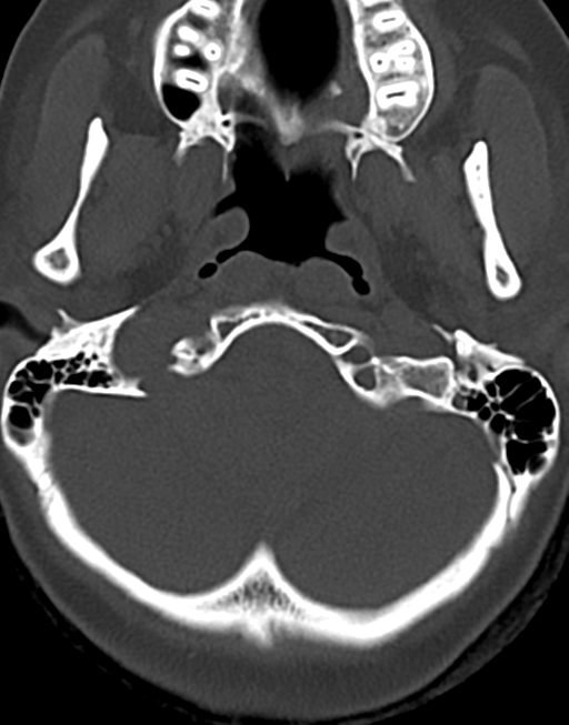 Cervical tuberculous spondylitis (Radiopaedia 39149-41365 Axial bone window 5).png