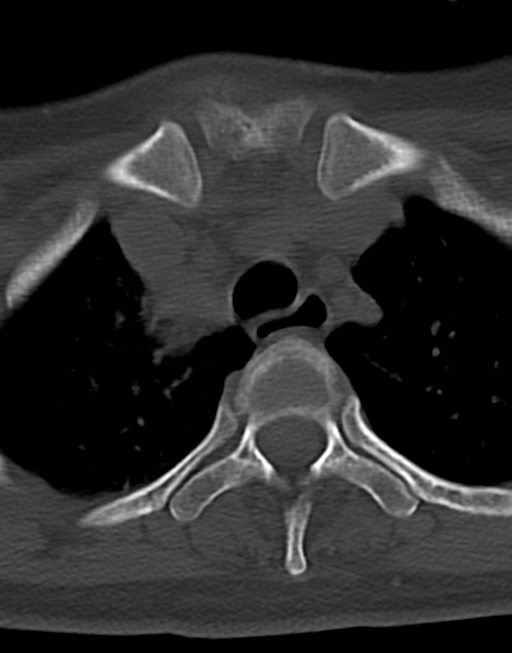 Cervical tuberculous spondylitis (Radiopaedia 39149-41365 Axial bone window 55).png