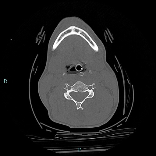 File:Cervical vertebral burst fracture (Radiopaedia 37420-39258 Axial bone window 47).jpg