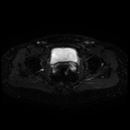 File:Cesarian section scar endometriosis (Radiopaedia 66520-75799 Axial DWI 19).jpg