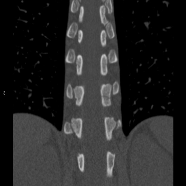 File:Chance fracture (Radiopaedia 36521-38081 Coronal bone window 34).jpg
