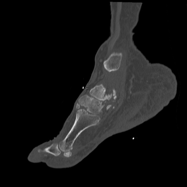 Charcot joint (Radiopaedia 36629-38194 Sagittal bone window 64).jpg