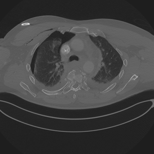 Chest multitrauma - aortic injury (Radiopaedia 34708-36147 Axial bone window 107).png