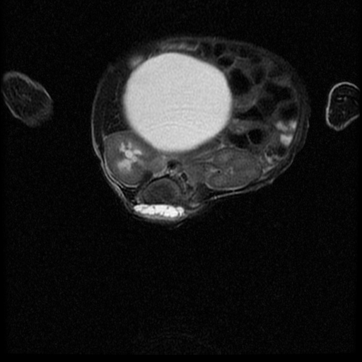 File:Chiari II malformation with spinal meningomyelocele (Radiopaedia 23550-23652 Axial T2 12).jpg