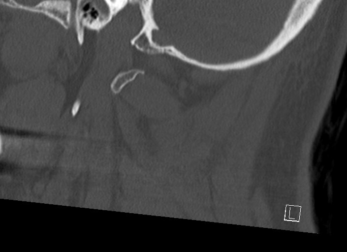 Chiari I malformation with a symptomatic syrinx of the posterolateral medulla oblongata (Radiopaedia 42573-45707 A 48).jpg