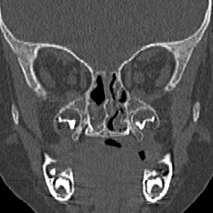 Choanal atresia (Radiopaedia 88525-105975 Coronal bone window 57).jpg