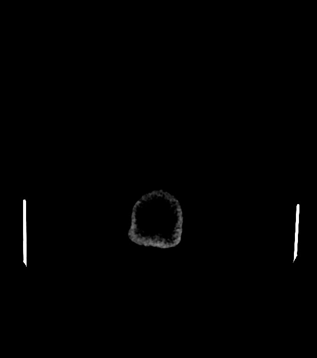 Cholangiocarcinoma with cerebral metastases (Radiopaedia 83519-98628 Axial non-contrast 67).jpg