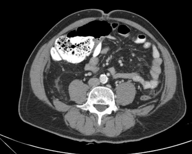 Cholecystitis - perforated gallbladder (Radiopaedia 57038-63916 A 51).jpg