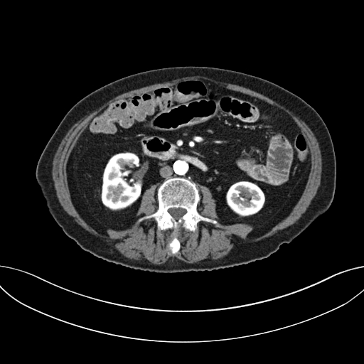 Cholecystoduodenal fistula due to calculous cholecystitis with gallstone migration (Radiopaedia 86875-103077 A 36).jpg