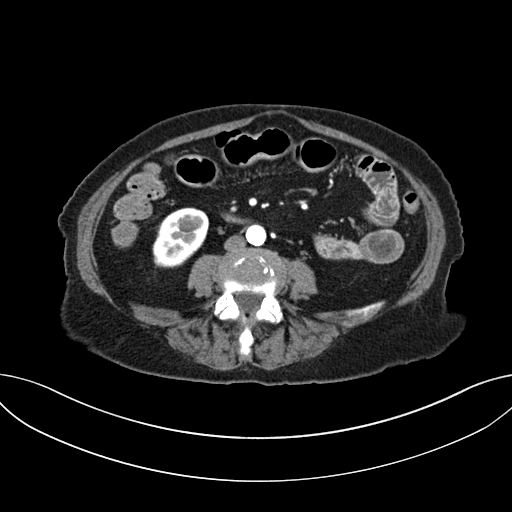 Cholecystoduodenal fistula due to calculous cholecystitis with gallstone migration (Radiopaedia 86875-103077 A 41).jpg