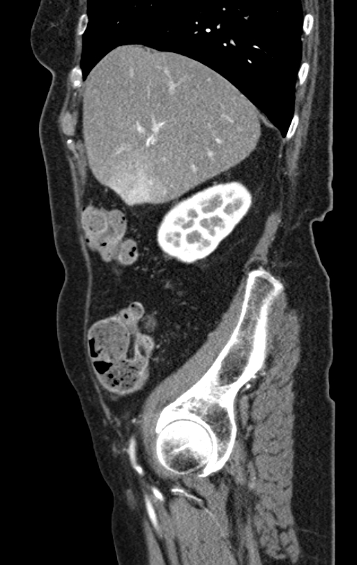 Cholecystoduodenal fistula due to calculous cholecystitis with gallstone migration (Radiopaedia 86875-103077 C 47).jpg
