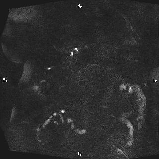Choledochal cyst - type Ia (Radiopaedia 85673-101454 F 23).jpg