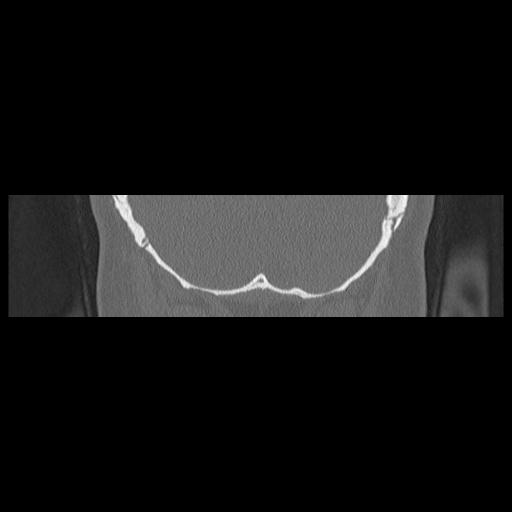 Cholesteatoma (Radiopaedia 84946-100455 Coronal bone window 139).jpg