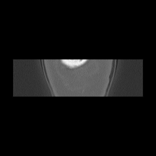 Cholesteatoma (Radiopaedia 84946-100455 Coronal bone window 172).jpg