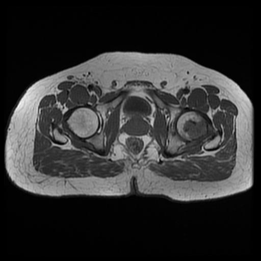File:Chondroblastoma (Radiopaedia 12264-12564 Axial T1 4).jpg