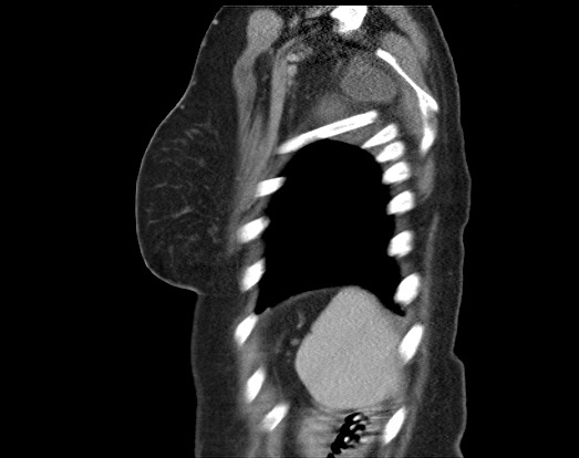 Chondrosarcoma - chest wall (Radiopaedia 65192-74199 B 10).jpg