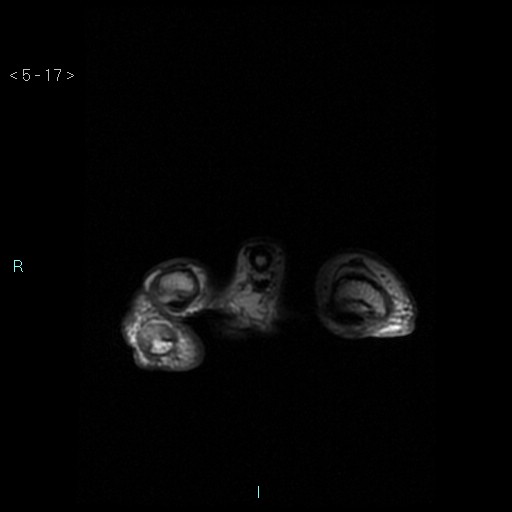 File:Chondrosarcoma - phalanx (Radiopaedia 69047-78813 Axial T1 17).jpg