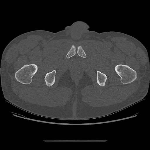 File:Chondrosarcoma of iliac wing (Radiopaedia 63861-72599 Axial bone window 120).jpg