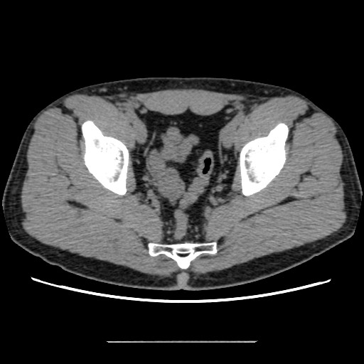 File:Chondrosarcoma of iliac wing (Radiopaedia 63861-72599 Axial non-contrast 87).jpg