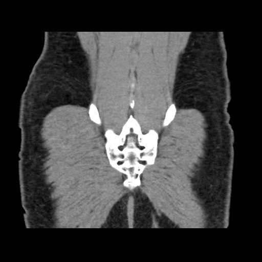 Chondrosarcoma of iliac wing (Radiopaedia 63861-72599 Coronal non-contrast 101).jpg