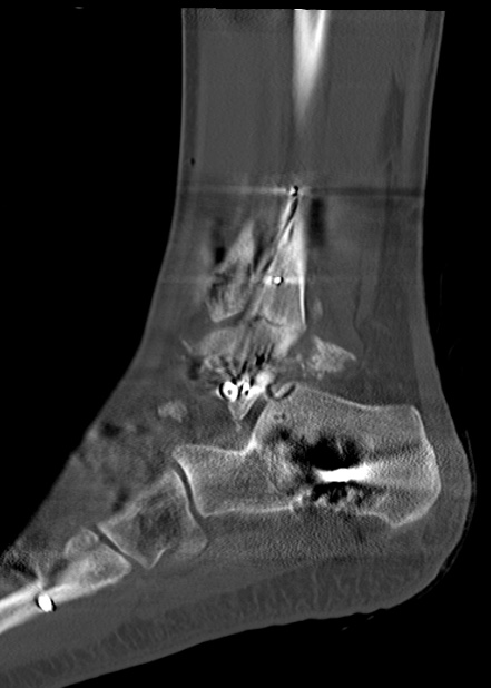 Chopart fracture (Radiopaedia 35347-36861 Sagittal bone window 52).jpg