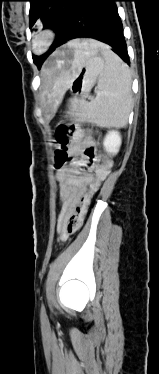 Choriocarcinoma liver metastases (Radiopaedia 74768-85766 C 59).jpg
