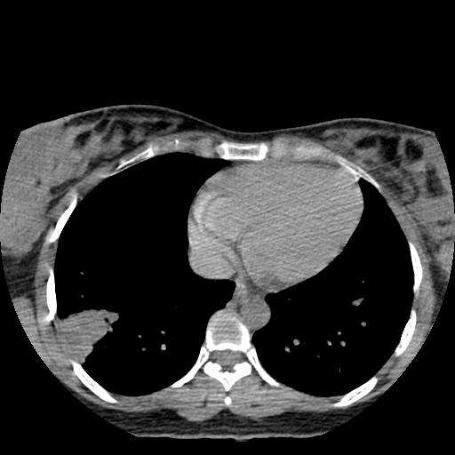 Choriocarcinoma of ovary with cerebral and pulmonary metastases (Radiopaedia 25983-26119 Axial non-contrast 12).jpg