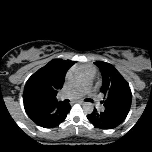 File:Choriocarcinoma of ovary with cerebral and pulmonary metastases (Radiopaedia 25983-26119 Axial non-contrast 128).jpg