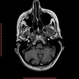 Choroid plexus xanthogranuloma (Radiopaedia 67843-77270 Axial T1 132).jpg
