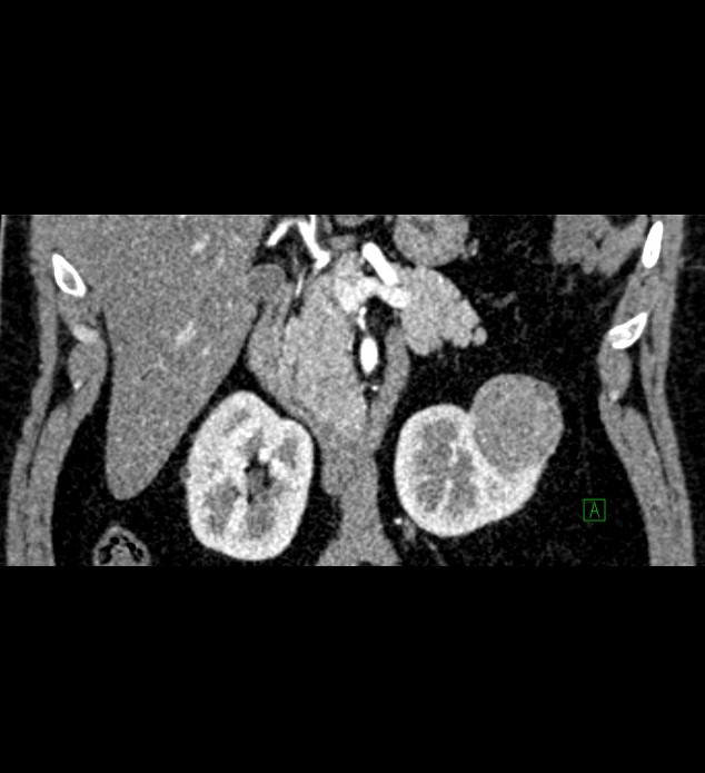 Chromophobe renal cell carcinoma (Radiopaedia 84286-99573 E 26).jpg