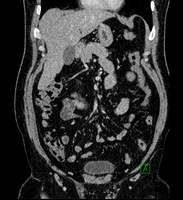 Chromophobe renal cell carcinoma (Radiopaedia 84286-99573 H 60).jpg