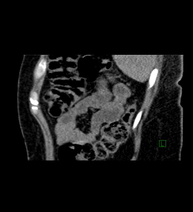Chromophobe renal cell carcinoma (Radiopaedia 84290-99582 D 14).jpg